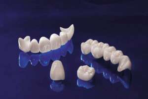 Emax crowns στην Αλβανία.
