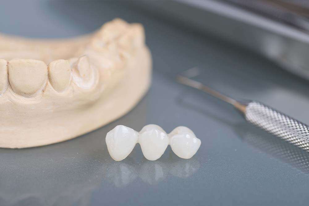 A piece of dental bridge teeth replacement.