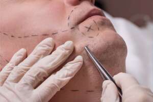 patient becoming ready for beard transplant in Albania.