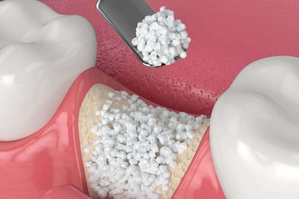 Dental Bone implanting and bone transplant in Albania. 