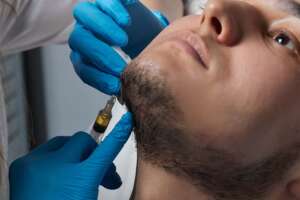 Beard Transplant for Boy in Albania.