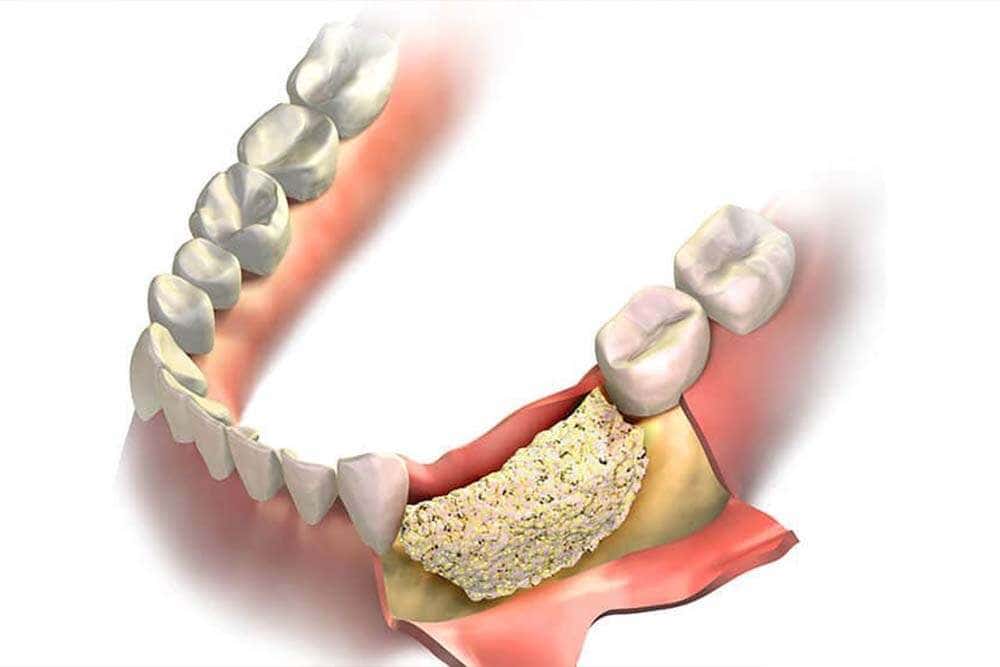 Bone grafting procedure before implants in Albania. 
