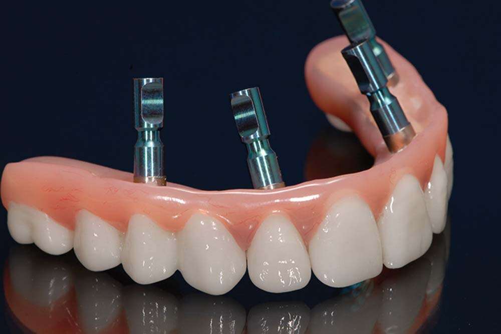 Photo de tous les implants dentaires sur 4 en Albanie. 
