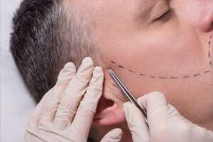 Beard Implantation for facial hair.