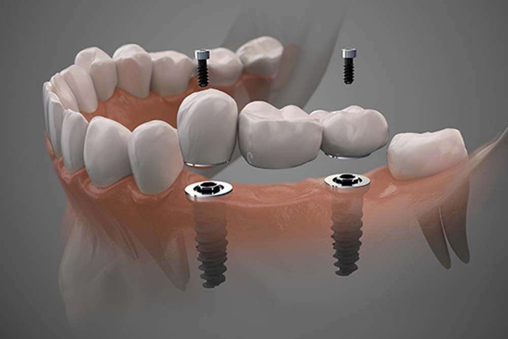 Tooth replacement in Albania with dental bridges. 