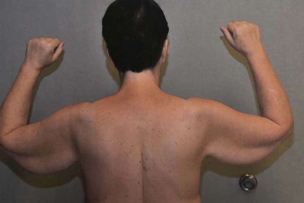 L'homme qui a besoin d'un lifting des bras pose avant l'opération.