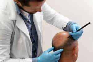 Sapphire FUE hair transplant procedure in Albania for effective hair restoration.