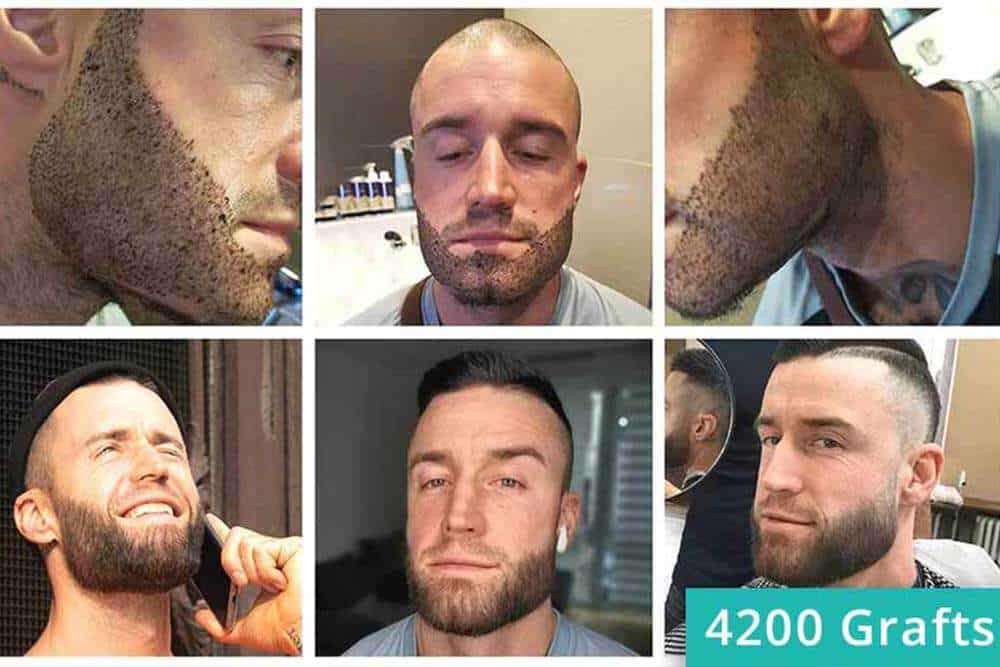4200 Grafts beard implantation facial hair
