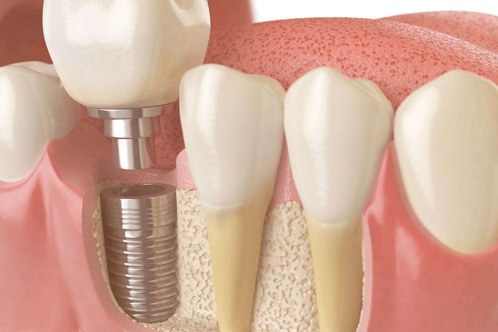 Implant being placed in Bone Graft. 