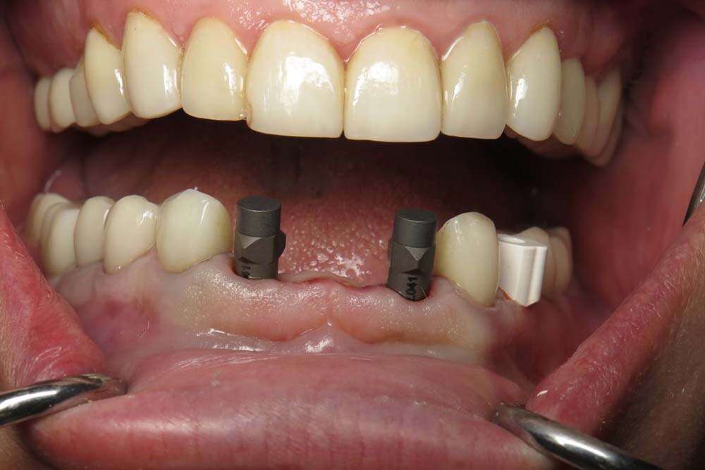 Patient before placing dental bridges. 