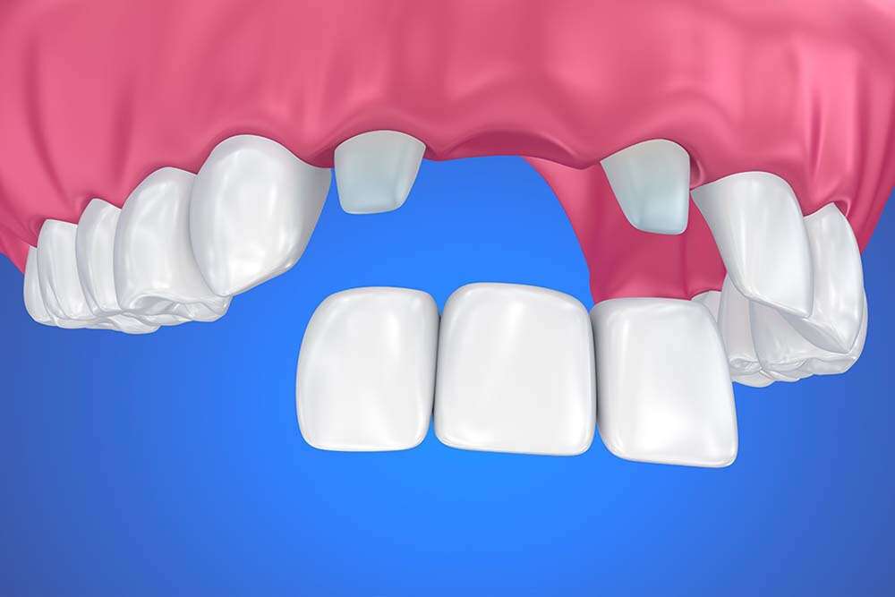 Implantation of dental bridge.