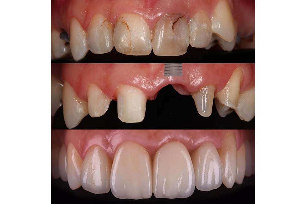 Fissare i denti con All on 4 impianti.