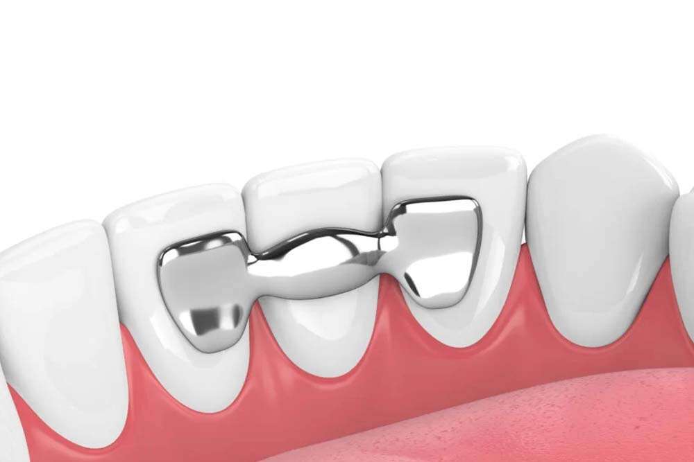 Illustration of bridge teeth.