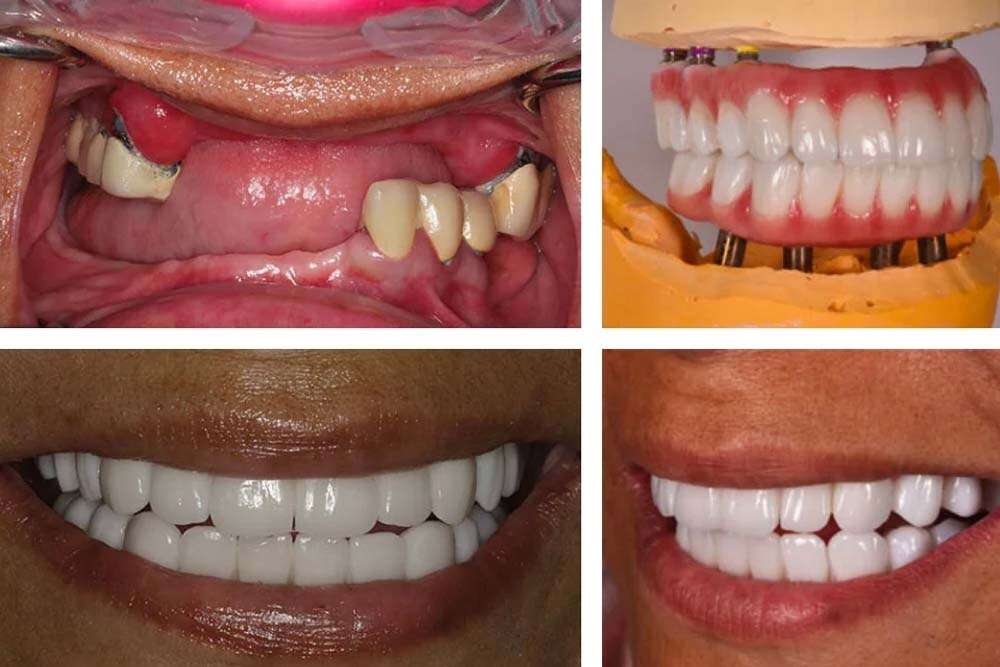 Paziente prima di fare tutto su 4 in Albania e dopo il trattamento implantare.