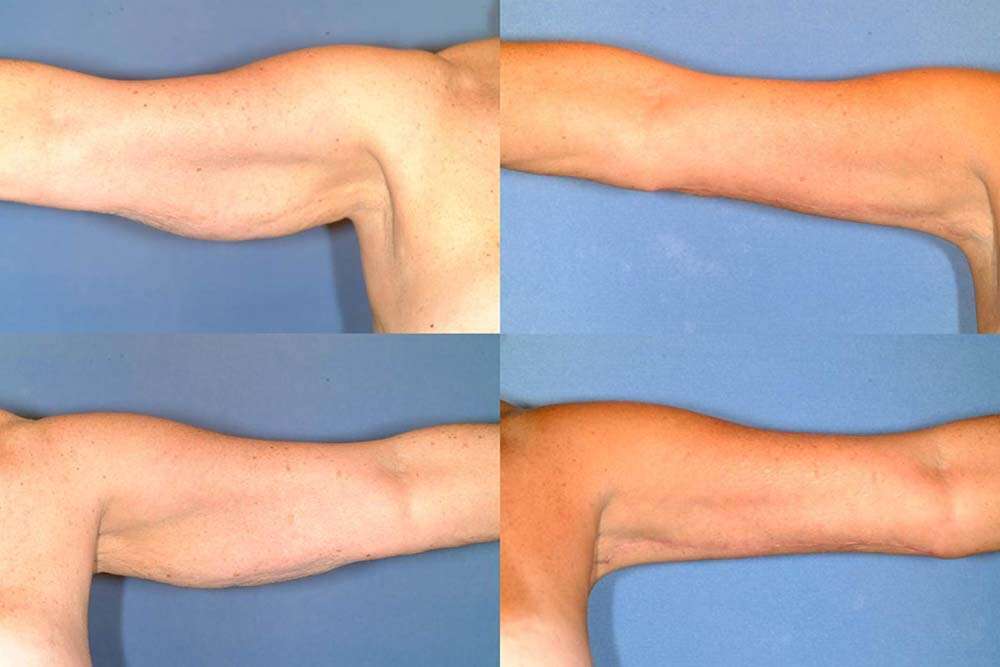 Meilleure chirurgie de lifting des bras en Albanie. 