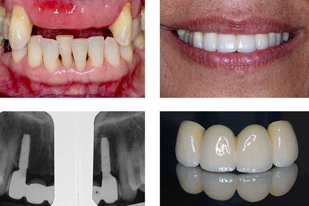 Patient from Europe in Albania results with dental bridges. 
