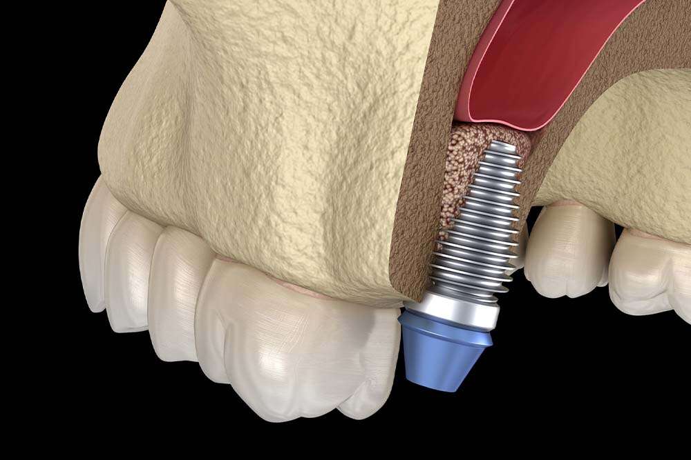 Implant being placed in artificial bone.