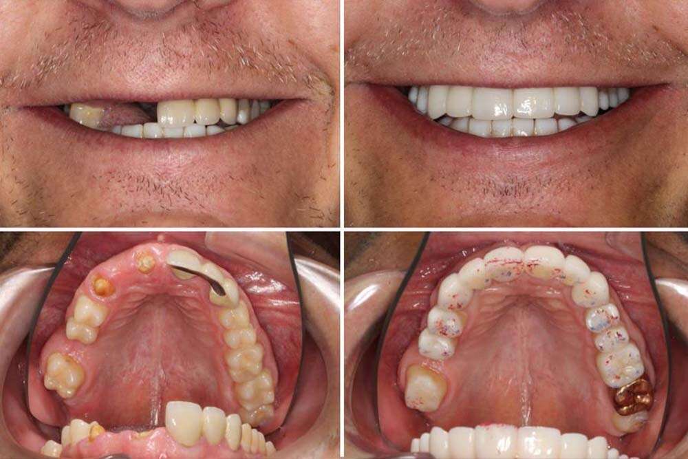 Dental Bridges in Albania results. 
