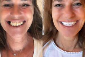 Before and after dental bone grafting in Albania for better dental health.
