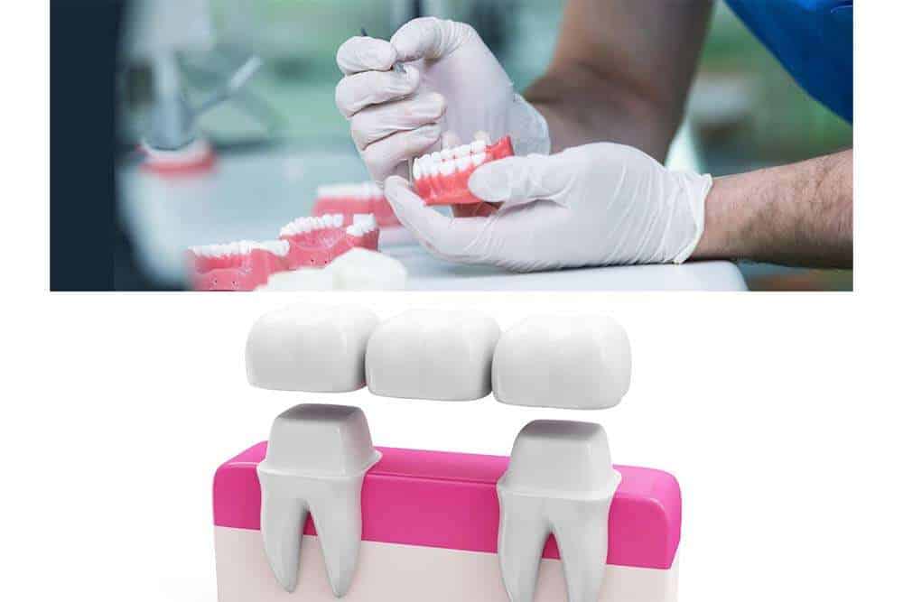 Dentist explaining dental bridges to patients.