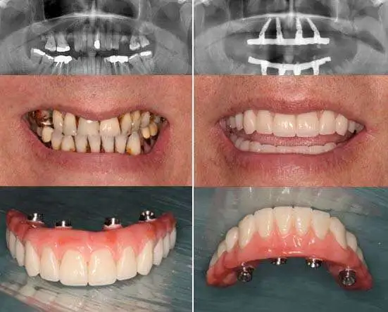Alles op 4 tandheelkundige implantaten Albanië. 
