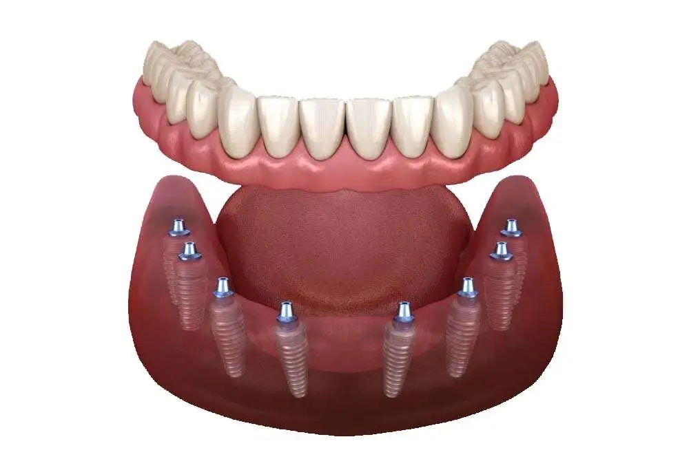 Allemaal op 8 implantaten in Albanië. 