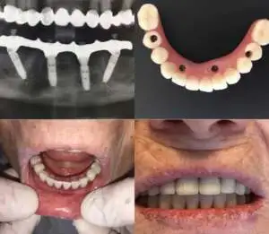 Tandheelkundige implantaatprocedure in Albanië voor effectieve tandvervanging.