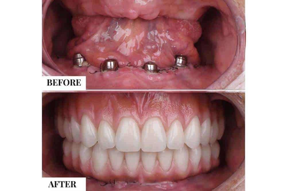 Procedura e implantit dentar rezultate para dhe pas në Shqipëri.
