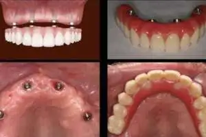 Een tandheelkundige implantaatprothese en bovenkaak met implantaten in Albanië voor tandherstel.