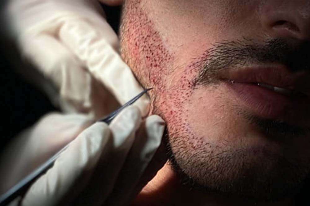 Procedure of beard transplantation on sides