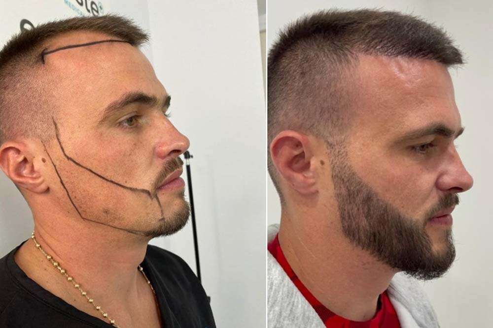Results of beard transplant in Albania