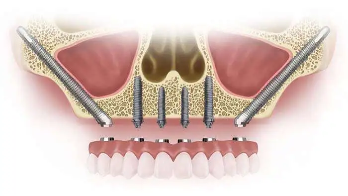 Zygomatische implantaten in Albanië. 