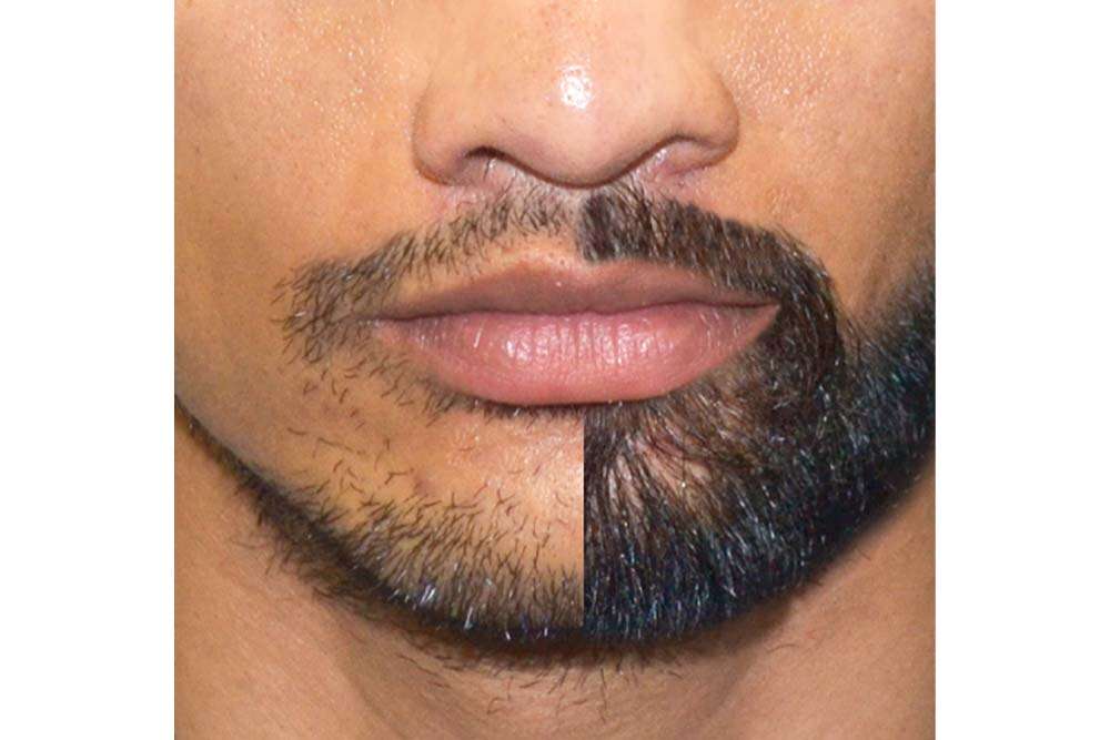 Before and after beard transplant. 