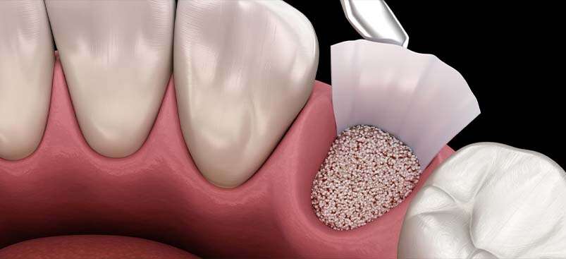 Bone Grafting in Albania.