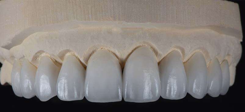 E-Max Crowns στην Αλβανία.