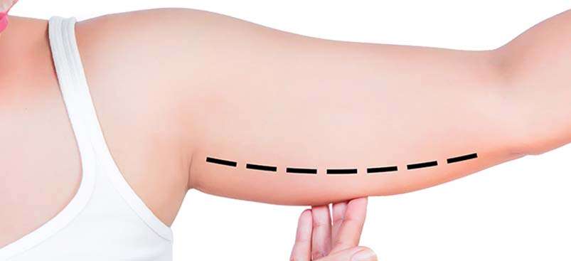 Lifting des bras en Albanie image qui montre ce que fait la chirurgie de brachioplastie.