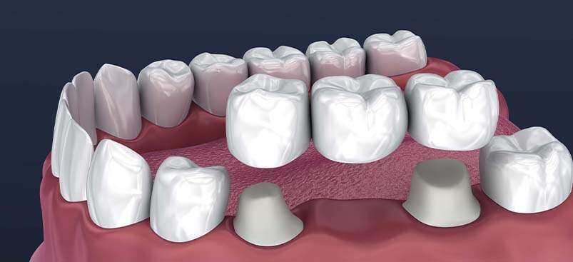 Dental Bridges in Albania.