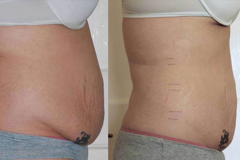 Before after liposuction in Albania.