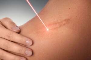 Littekenverwijdering met laser in Albanië.
