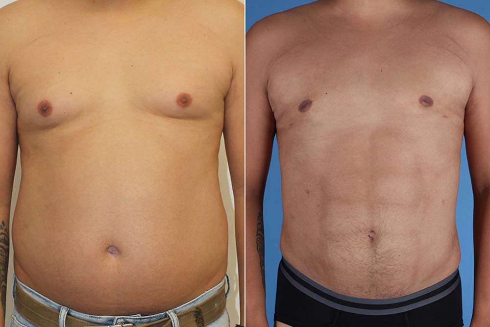 Φίλε αποτελέσματα μετά liposuction για την παχιά αφαίρεση χειρουργική επέμβαση στην Αλβανία.