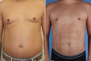 Résultats pour un homme après une liposuccion en Albanie.