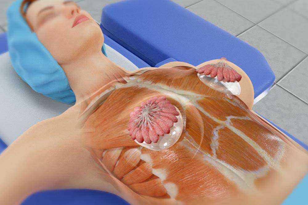 Implants mammaires pour forte poitrine en Albanie.