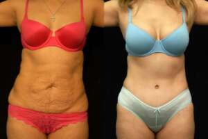 Voorste resultaten van de mommy makeover.