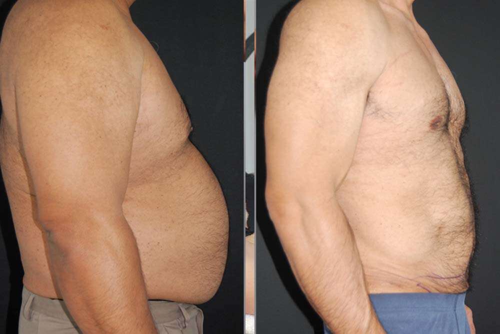 La chirurgie d'élimination des graisses chez l'homme en Albanie : des résultats parfaits grâce au laser lipo.