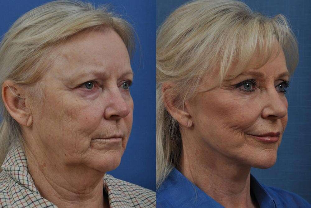 Incredibili risultati prima e dopo il lifting in Albania