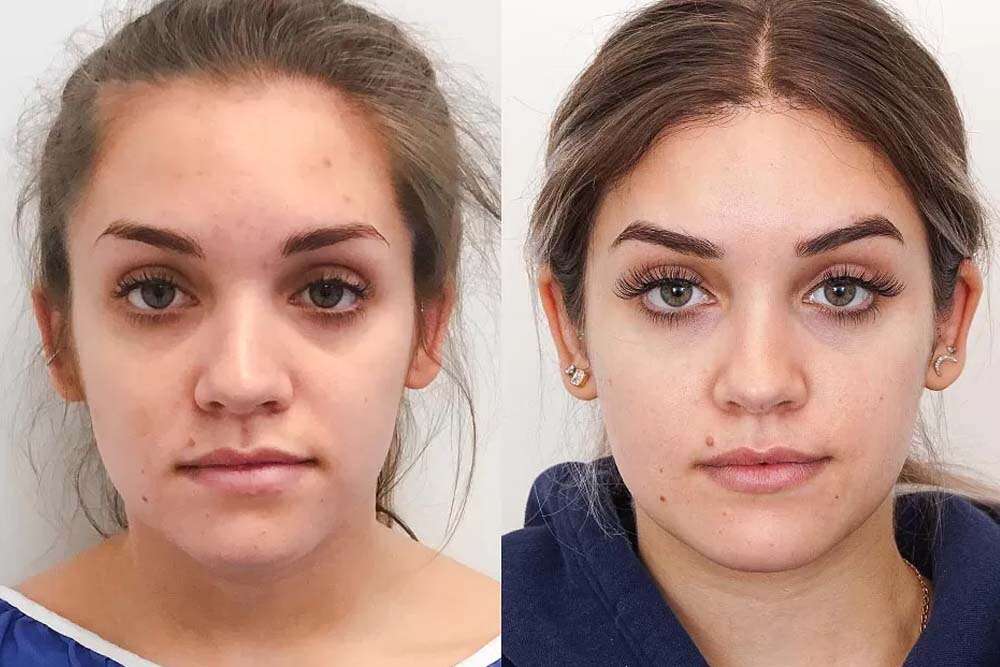 Vor und nach dem Brauenlifting in Albanien