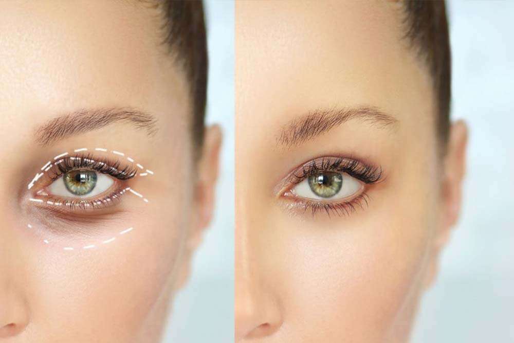 Blépharoplastie en Albanie par des spécialistes en oculoplastie