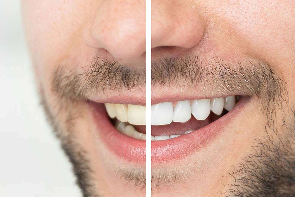 Confronto prima e dopo il trattamento di sbiancamento dentale con laser in Albania