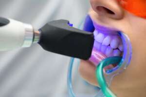 Trattamento sbiancante dentale con attrezzature avanzate in una clinica in Albania.