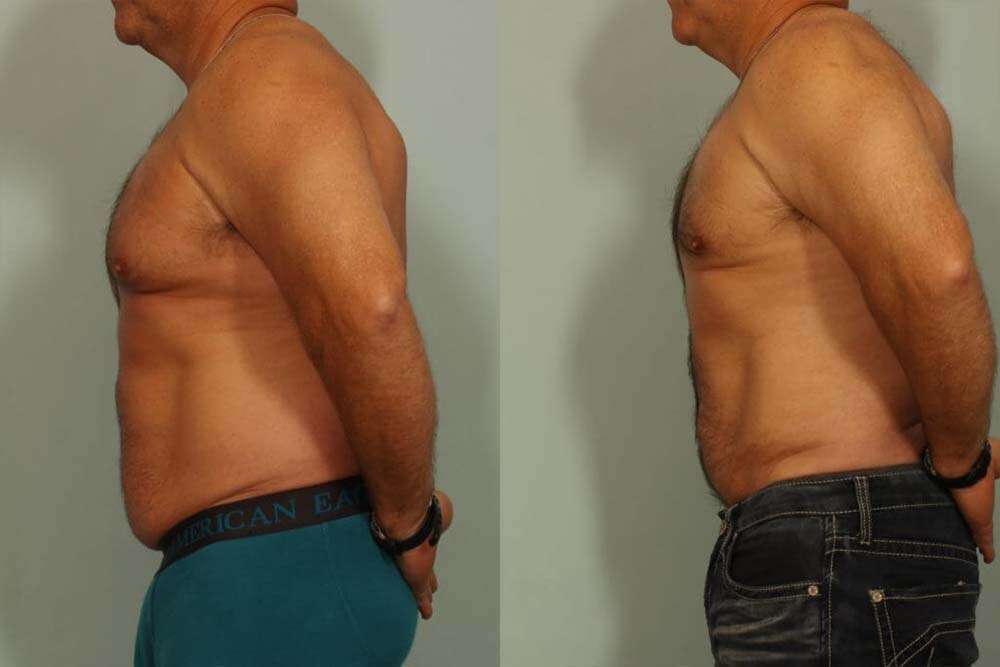 Liposuction me laser në Shqipëri për pacientët meshkuj